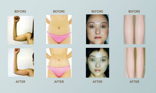 Remove face fat without surgery picture 10