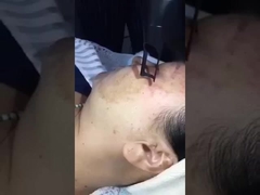 3-in-1 Picosecond Laser Machine - Remove Spots & Tattoos Safely