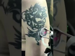 3-in-1 Picosecond Laser Machine - Remove Spots & Tattoos Safely